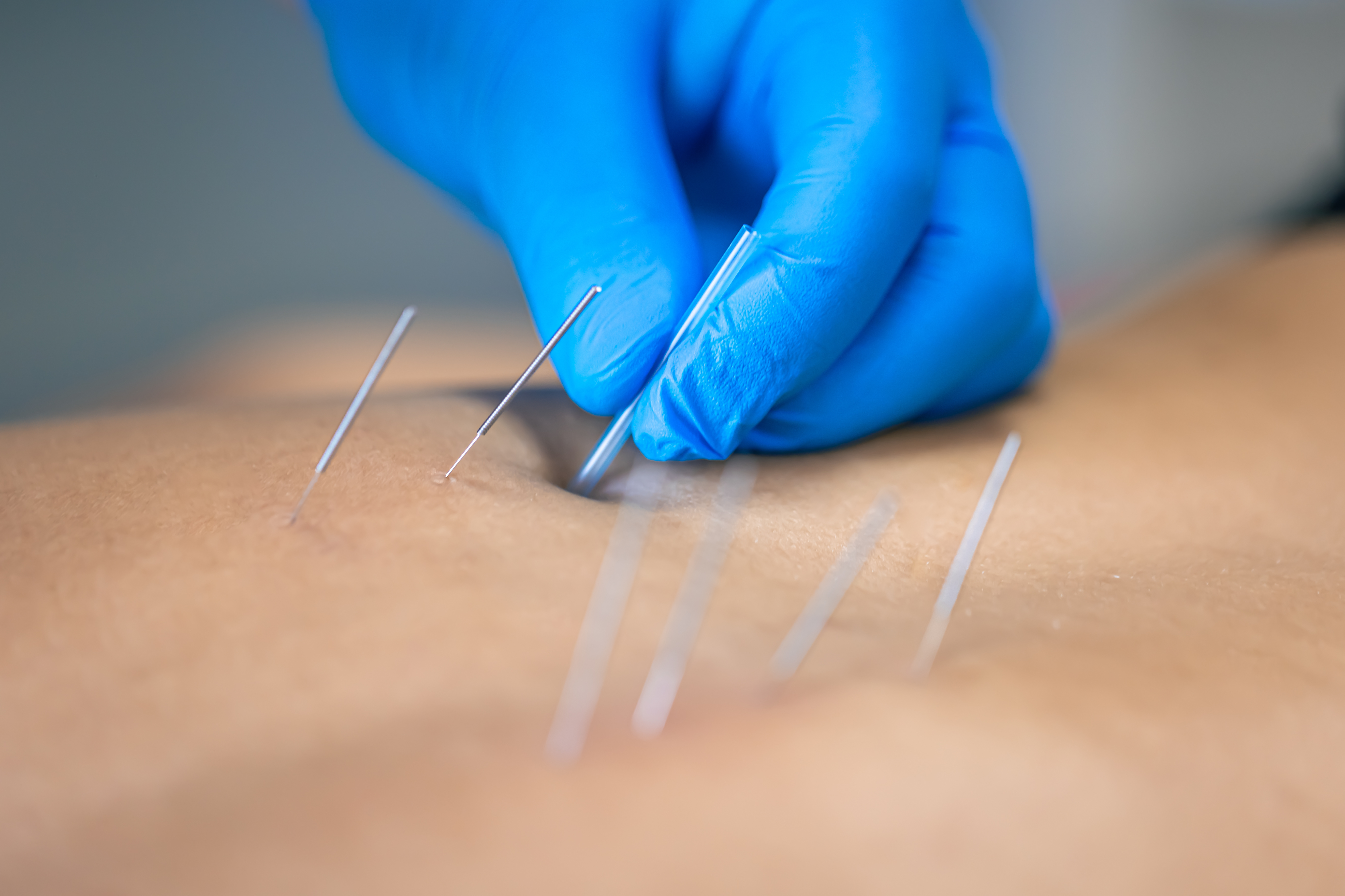 Dry Needling at Everything Physical Therapy